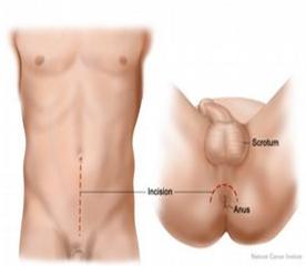 Two types of radical prostatectomy. In a retropubic prostatectomy, the prostate is removed through an incision in the wall of the abdomen. In a perineal prostatectomy, the prostate is removed through an incision in the area between the scrotum and the anus.