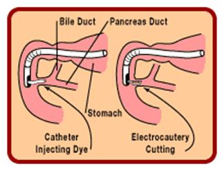 ERCP Procedure