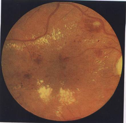 maculopatie diabetica pg 8 lucrare