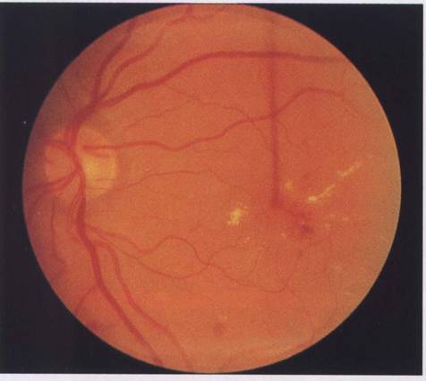 maculopatia diabetica pg 8 lucrare